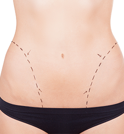 360°-Hi-Def-Liposuction-dr-h-4